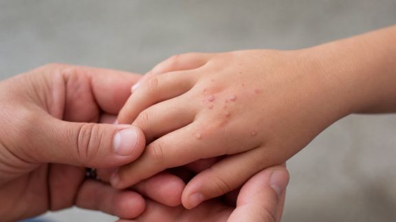 Reconnaître et traiter les verrues et molluscums chez les plus jeunes
